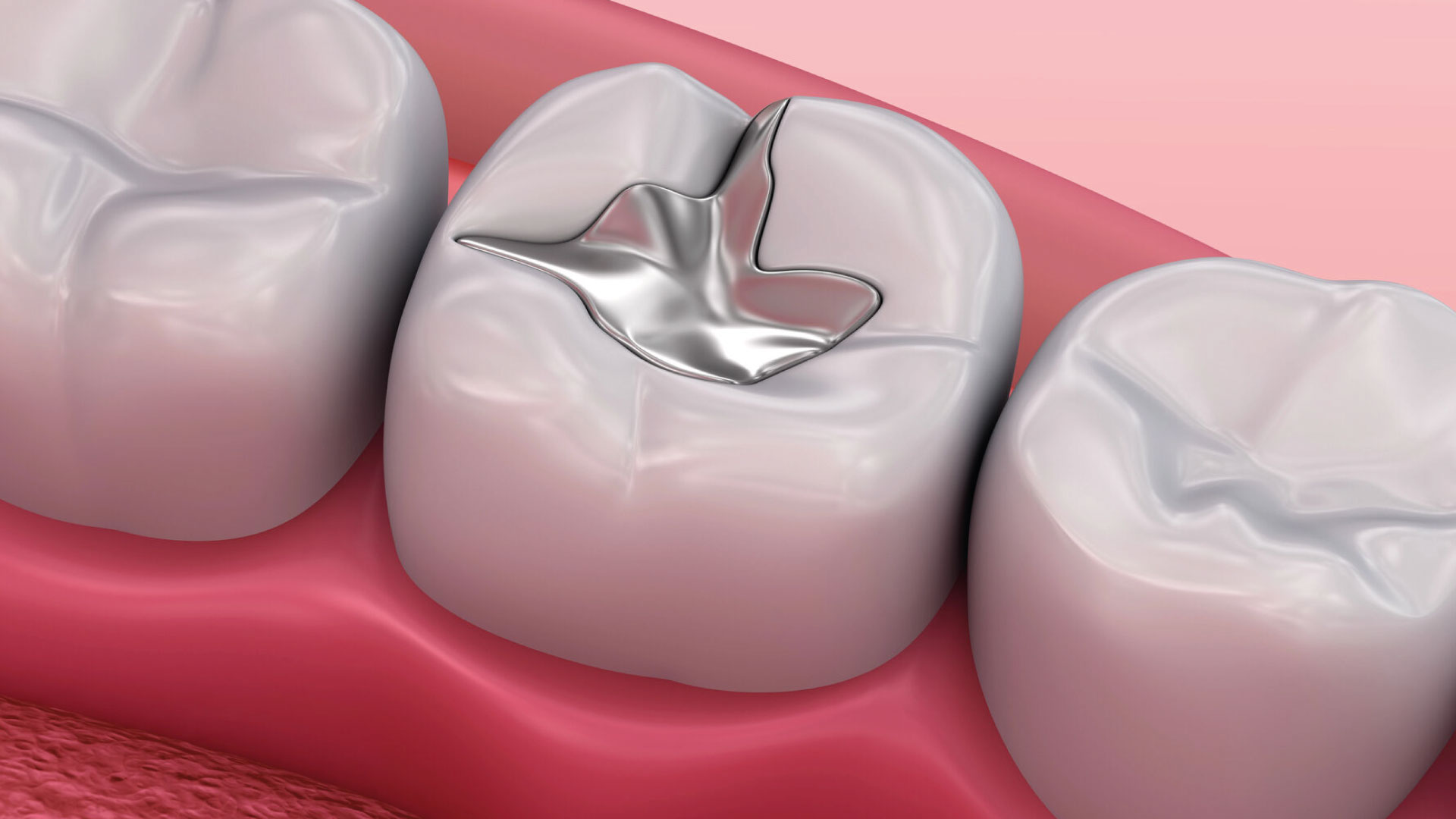 Image of three teeth with a metal repair. The central tooth displays a silver filling covering part of the chewing surface, while the adjacent teeth are intact and free of restorations. The structure of the teeth is visible against a light pink background representing the gum. The image highlights the contrast between the shiny metal of the filling and the natural appearance of the surrounding teeth.