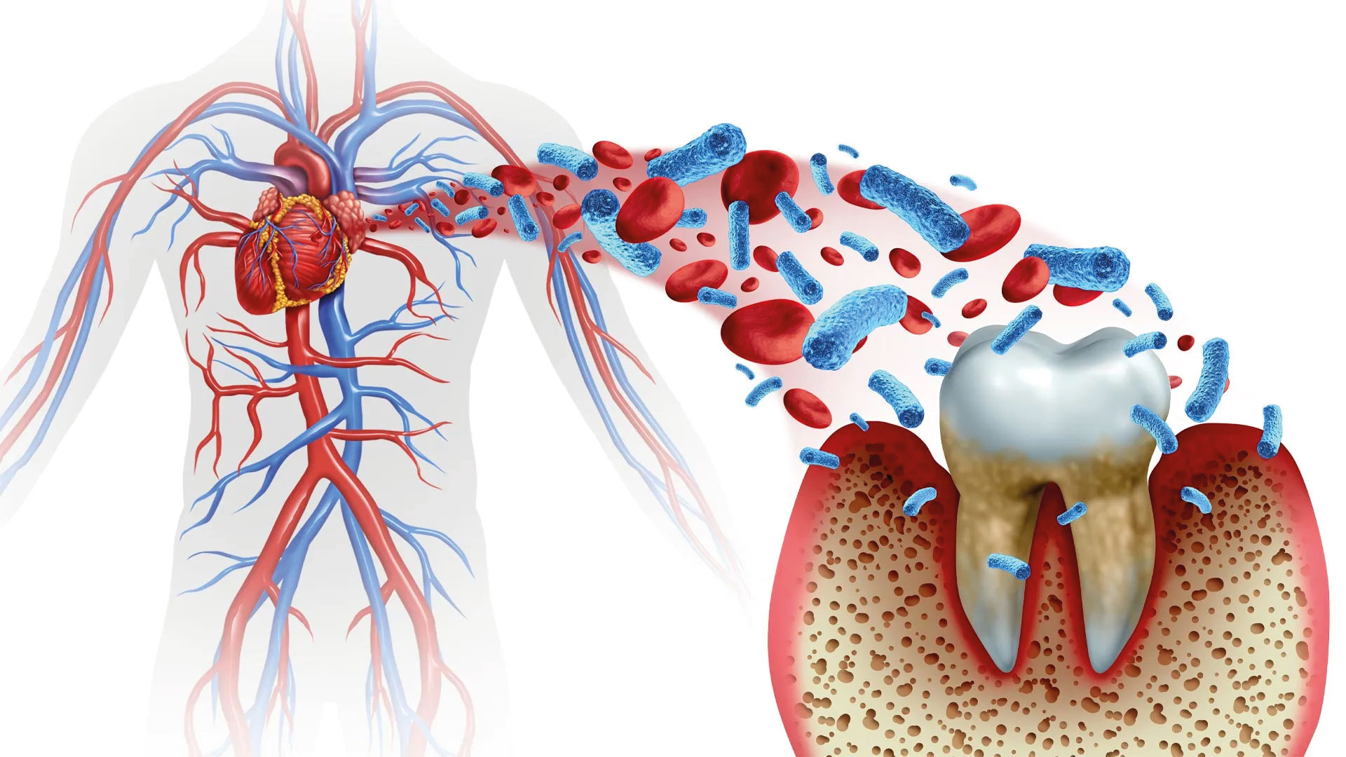 A detailed medical illustration depicting oral bacteria and red blood cells moving from a diseased tooth and gum area towards the human cardiovascular system, symbolizing the profound link between oral health and systemic well-being.